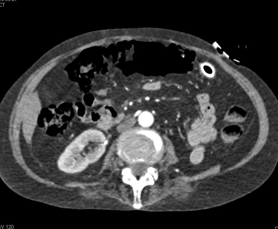 Extensive Pneumatosis of the Colon Without Ischemia - CTisus CT Scan