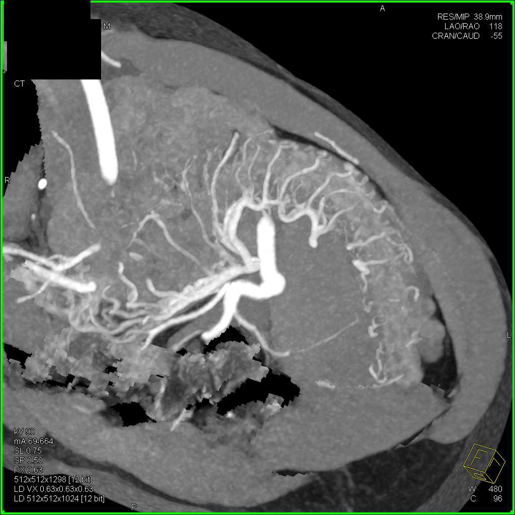 Colitis Involves the Sigmoid Colon - CTisus CT Scan