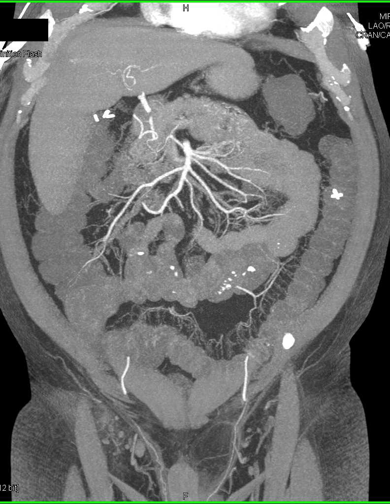 Acute Bleed Left Colon due to Diverticulitis - CTisus CT Scan