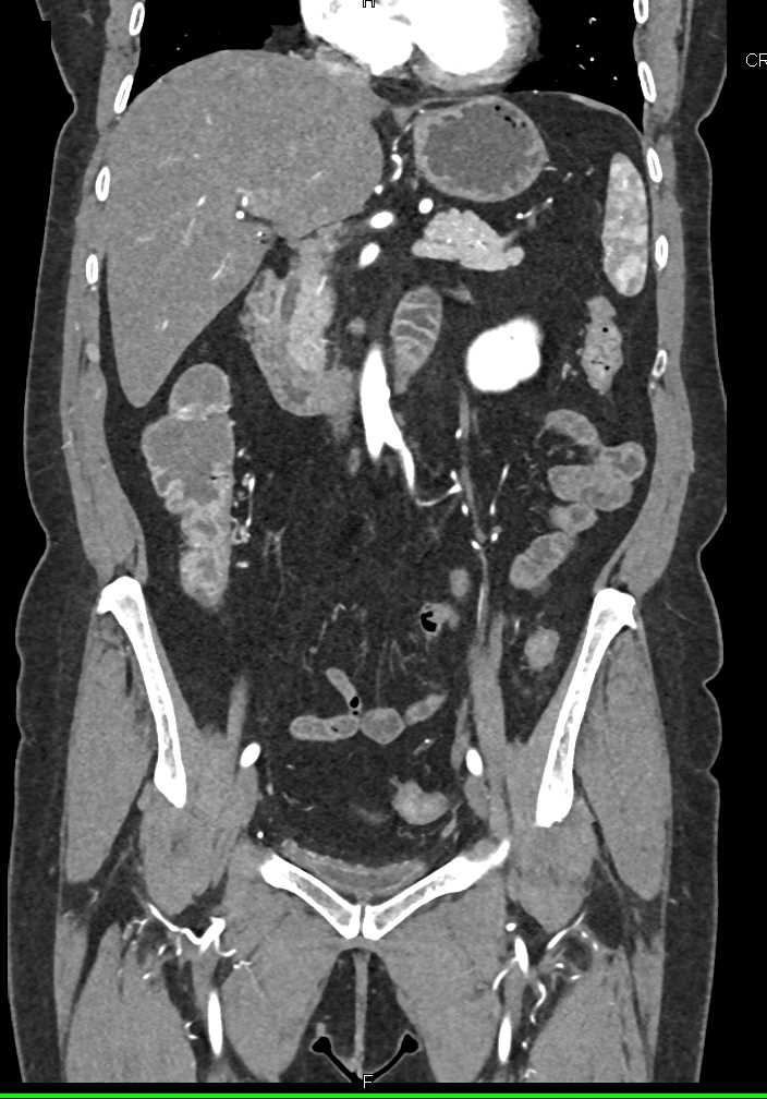 Colitis Right Colon - CTisus CT Scan