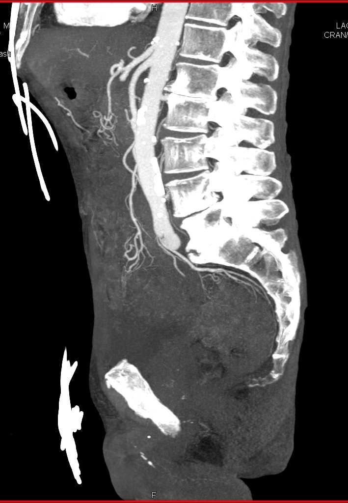 Rectal Cancer and Gastrointestinal (GI) Bleed - CTisus CT Scan