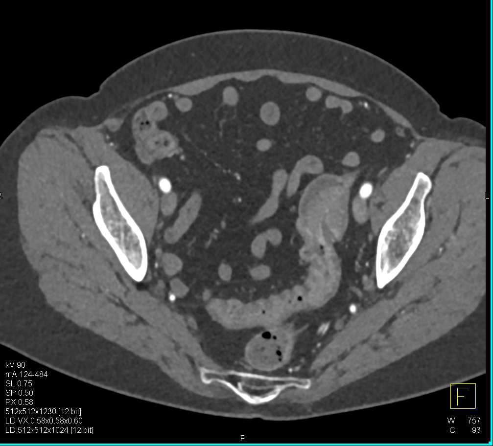 Sigmoid Colon Carcinoma - CTisus CT Scan