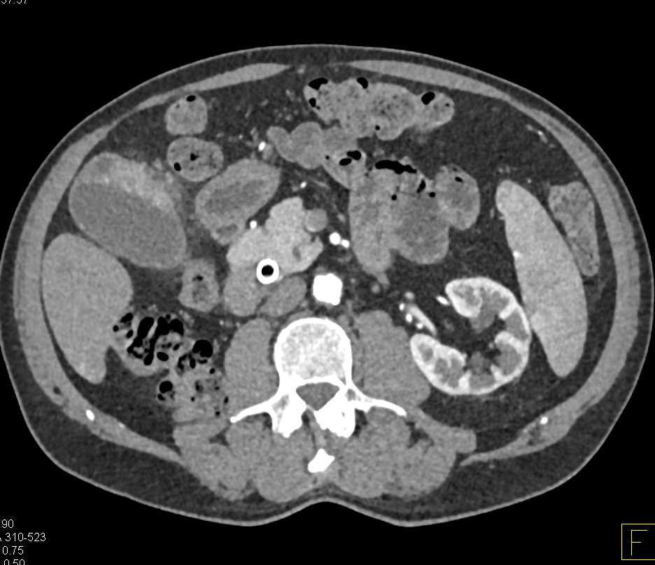 Carcinoma of the Gastric Antrum - CTisus CT Scan