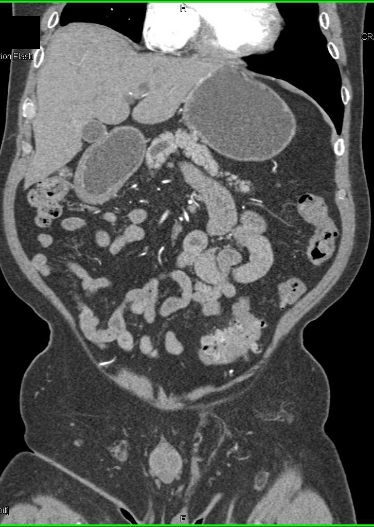 Diverticulitis with Subtle Bleed - CTisus CT Scan