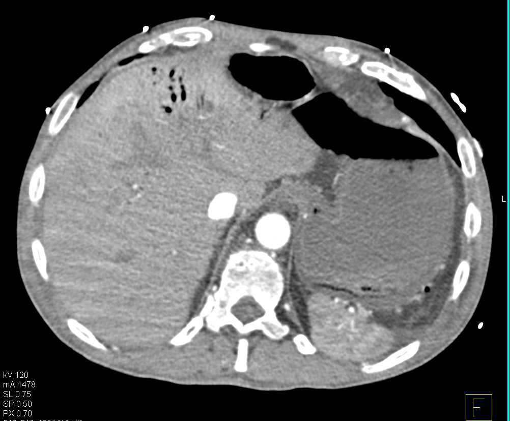 Rectal Carcinoma - CTisus CT Scan