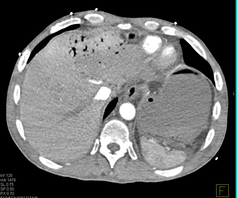 Rectal Carcinoma - CTisus CT Scan