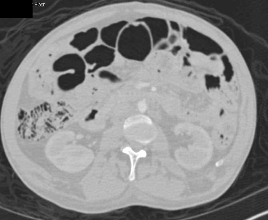 Pneumatosis Coli - Colon Case Studies - CTisus CT Scanning