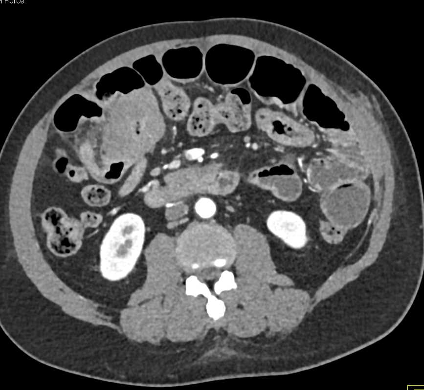 Colon Cancer Right Colon - CTisus CT Scan