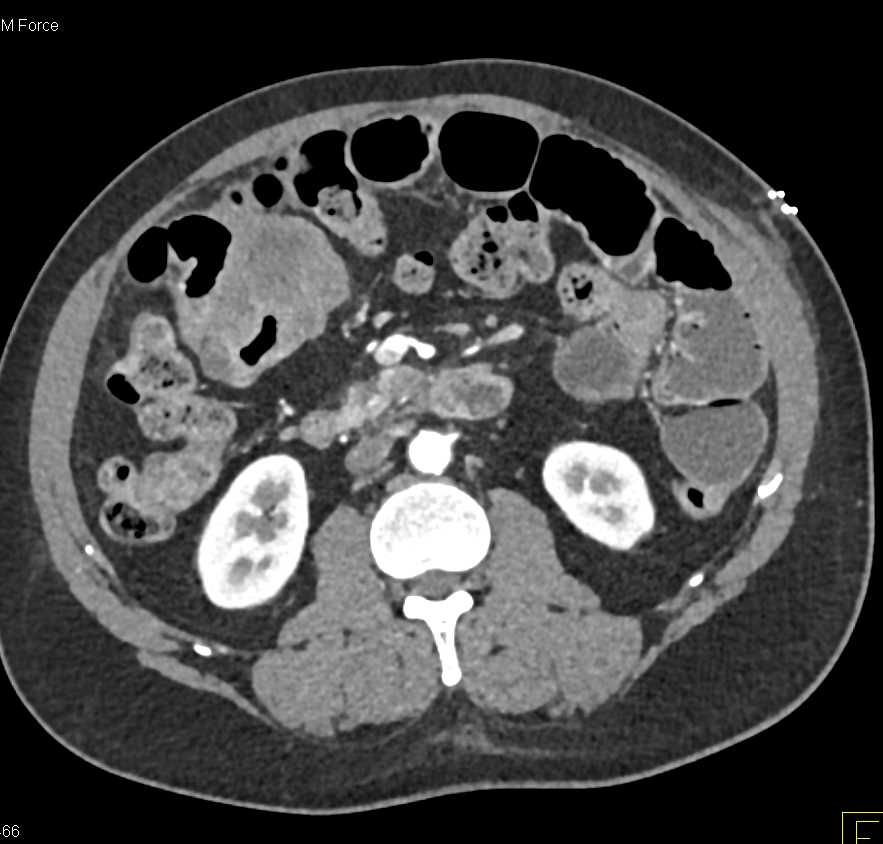 Colon Cancer Right Colon with 1cm Liver Metastases - CTisus CT Scan