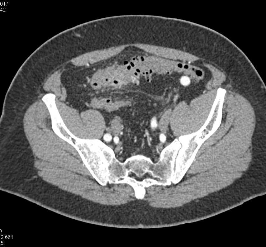 Diverticulitis with Focal Inflammation - CTisus CT Scan