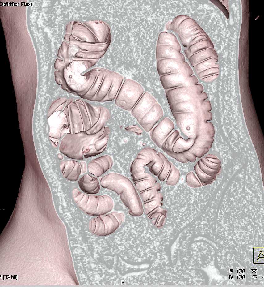 Diverticuli and Virtual Colonoscopy - CTisus CT Scan