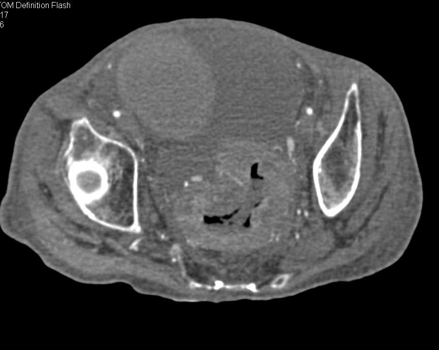 Pseudomembranous Colitis - CTisus CT Scan