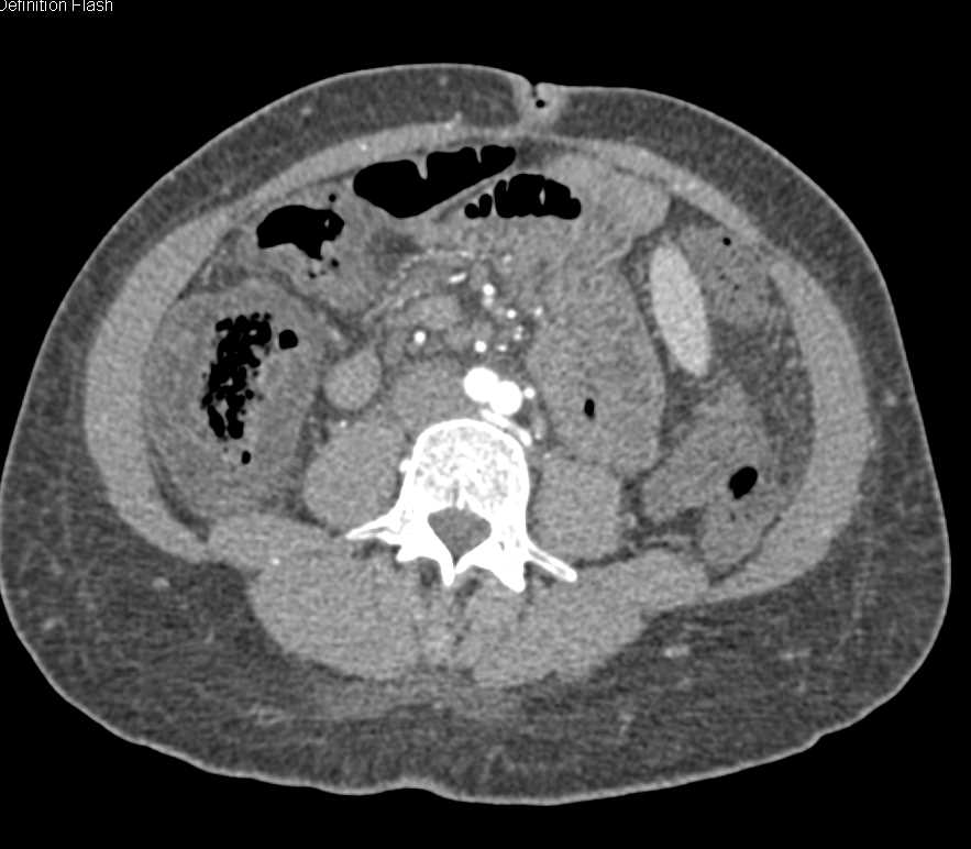 Typhlitis of the  Cecum - CTisus CT Scan