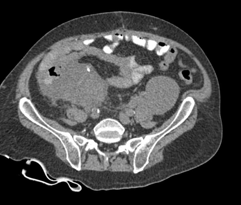 Cecal Carcinoma - CTisus CT Scan