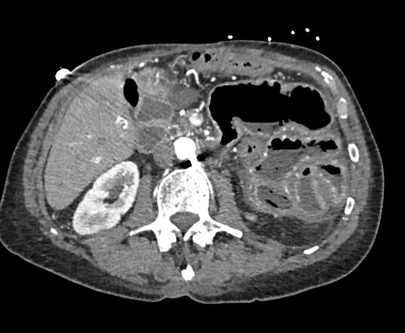 Colitis due to Infectious Etiology - CTisus CT Scan