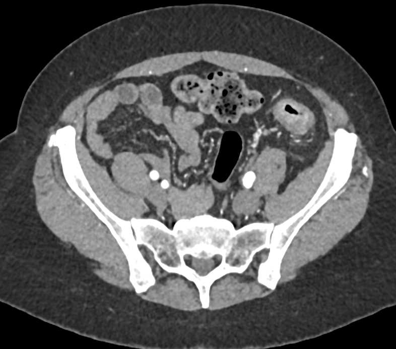 Ulcerative Colitis - CTisus CT Scan