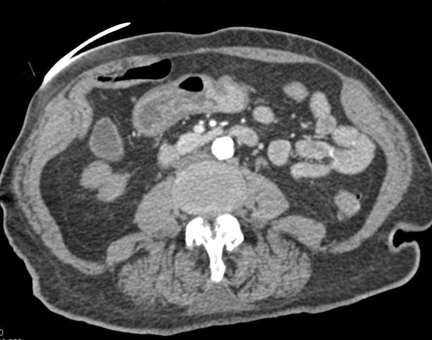 Diverticular Disease Descending and Sigmoid Colon - CTisus CT Scan