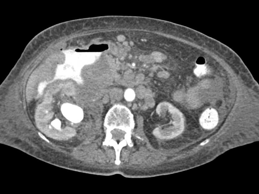 Lymphoma of the Right Colon - CTisus CT Scan