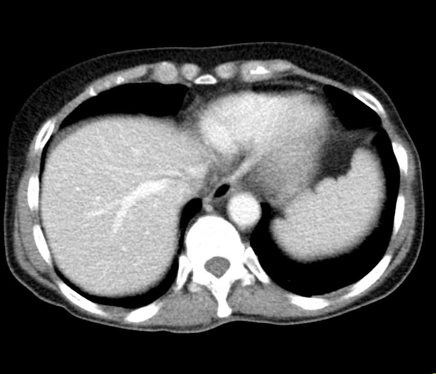 Cecal Cancer with Pseudomyxoma Peritonei - CTisus CT Scan