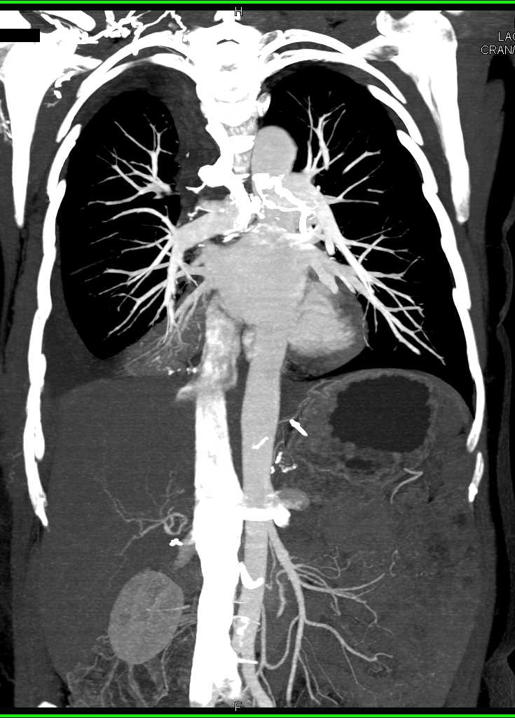 Angiodysplasia Right Colon and Cecum - CTisus CT Scan