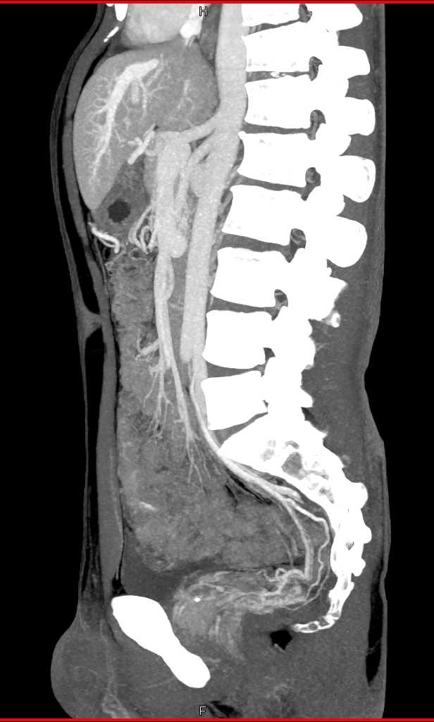Rectal Varices and GI Bleeed - CTisus CT Scan