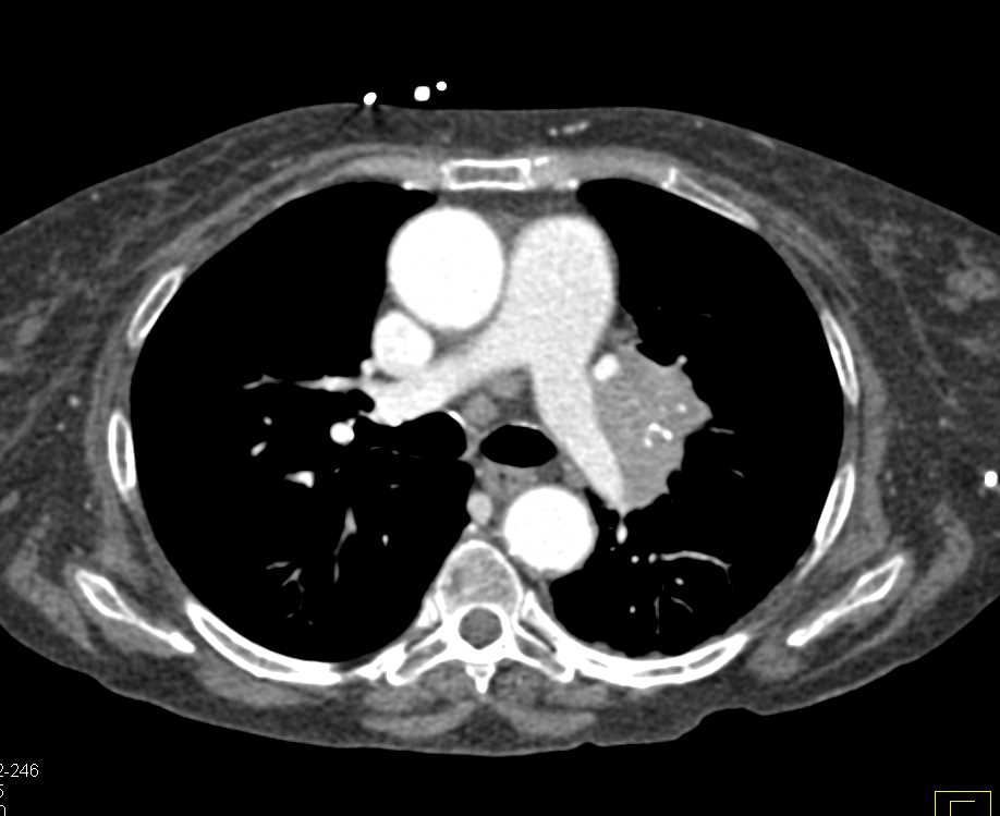 Lipoma in the Right Colon with Small Cell Lung Cancer - CTisus CT Scan
