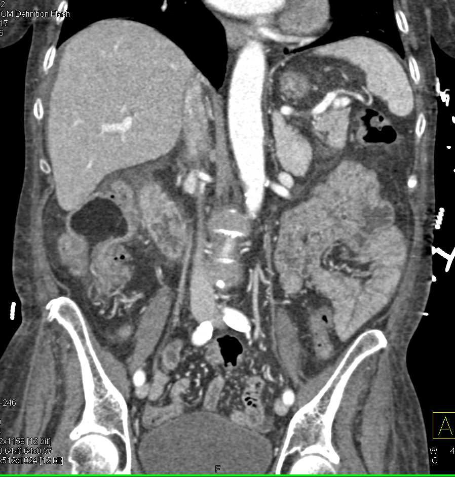 Lipoma in the Right Colon with Small Cell Lung Cancer - CTisus CT Scan