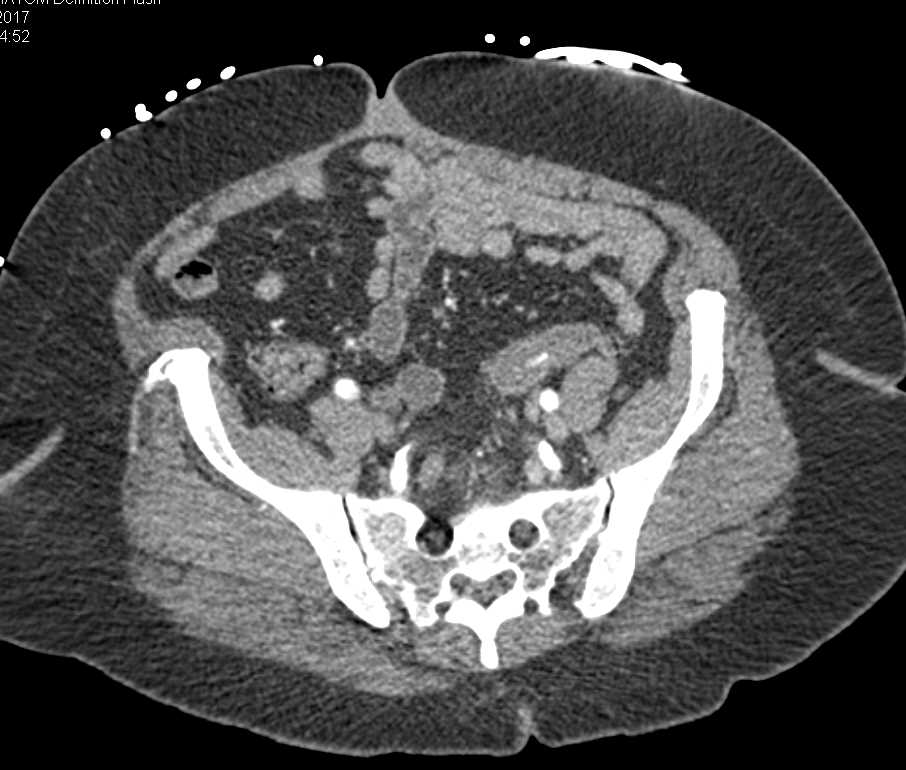 Active Bleed Near Splenic Flexure - CTisus CT Scan