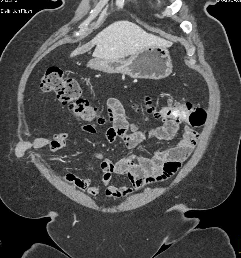 Active Bleed Near Splenic Flexure - CTisus CT Scan