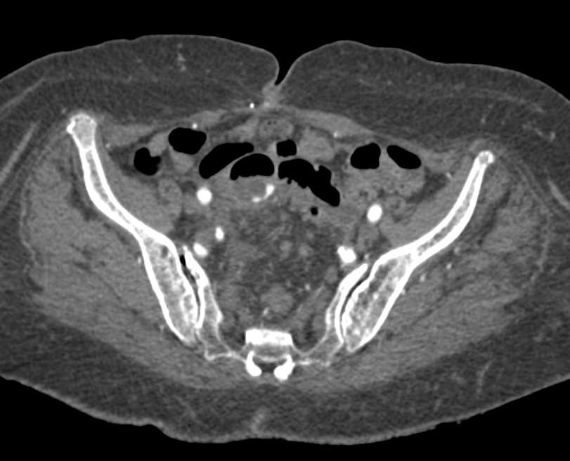 Post Colon Surgery Changes in the Pelvis - CTisus CT Scan