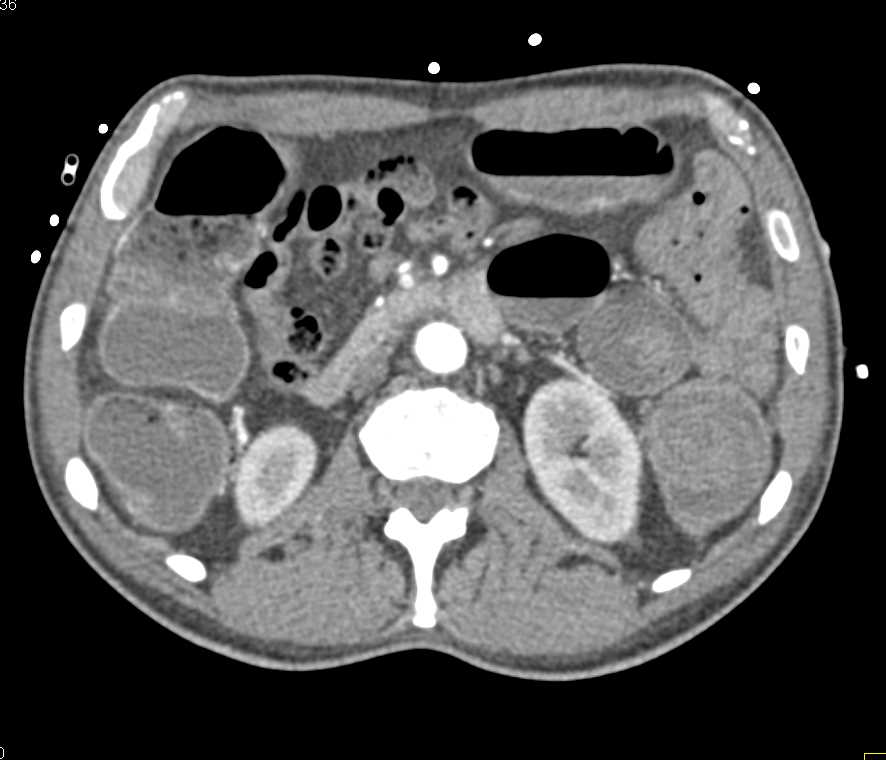 Gastrointestinal (GI) Bleed in the Descending Colon - CTisus CT Scan