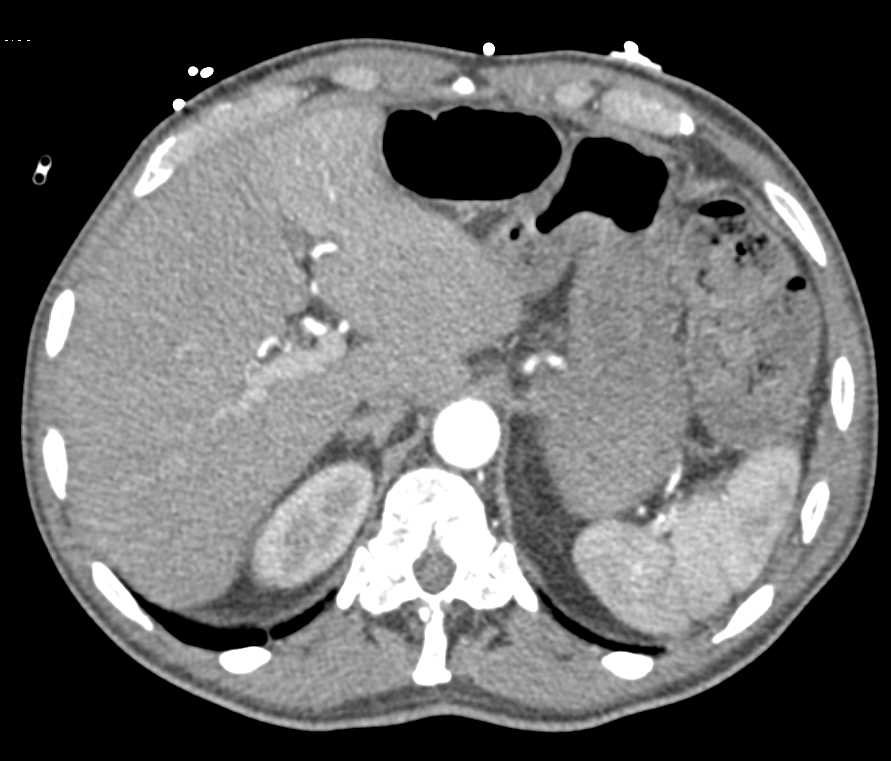 Gastrointestinal (GI) Bleed in the Descending Colon - CTisus CT Scan