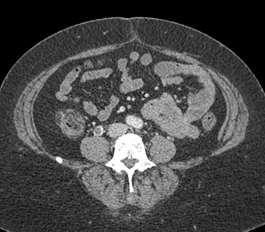 Crohn's Disease of the Right Colon and Cecum - CTisus CT Scan