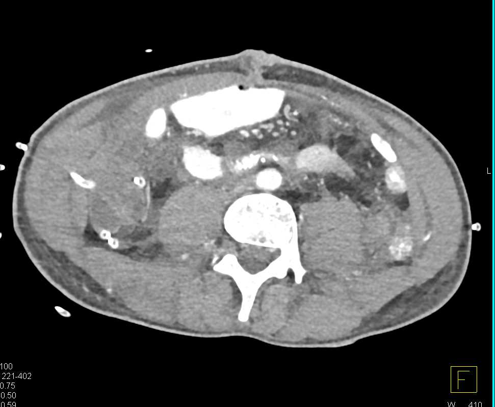 Post Op Changes with Drains in Place - CTisus CT Scan