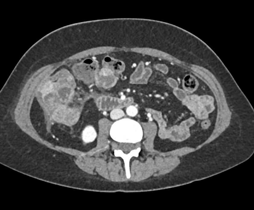 Colon Cancer with Carcinomatosis - Colon Case Studies - CTisus CT Scanning