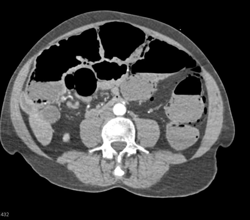 Pneumatosis Coli Left Colon due to Ischemia - CTisus CT Scan