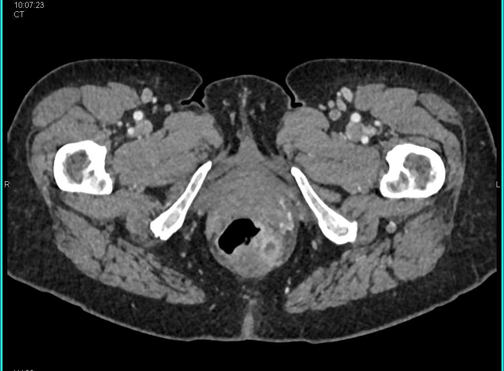 Perirectal Abscess on the Left Side - CTisus CT Scan