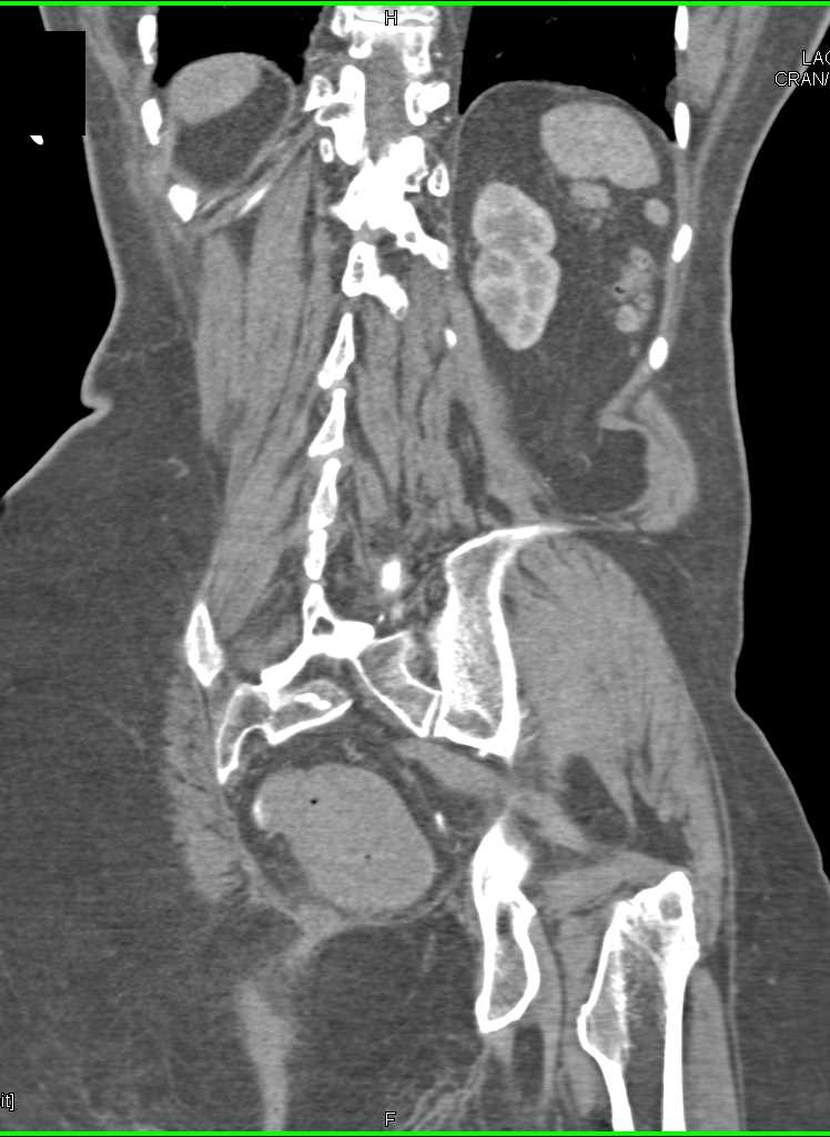 Gastrointestinal (GI) Bleed due to Rectal Ulcer - CTisus CT Scan