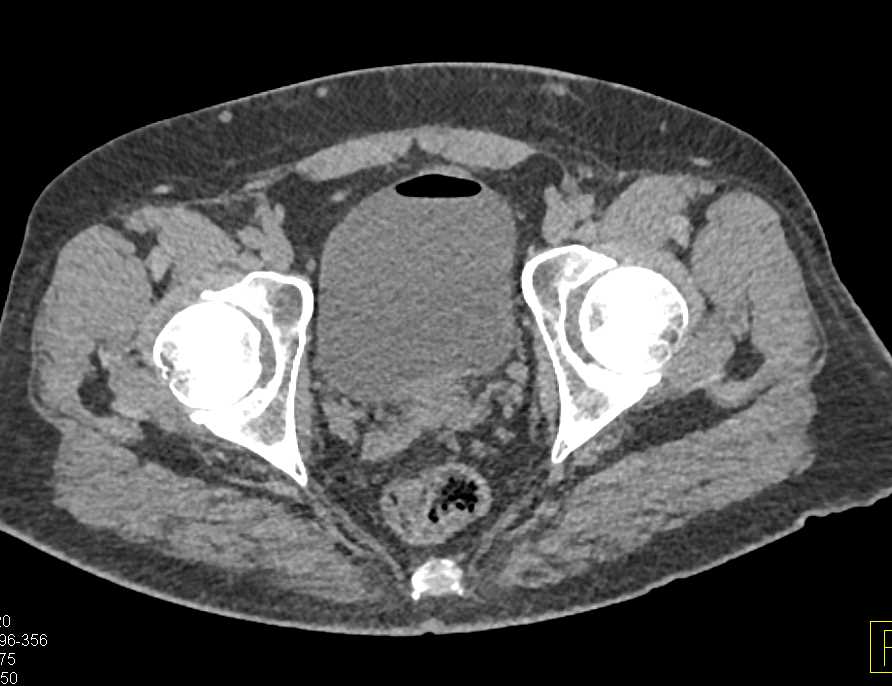 Colovesical Fistulae - CTisus CT Scan