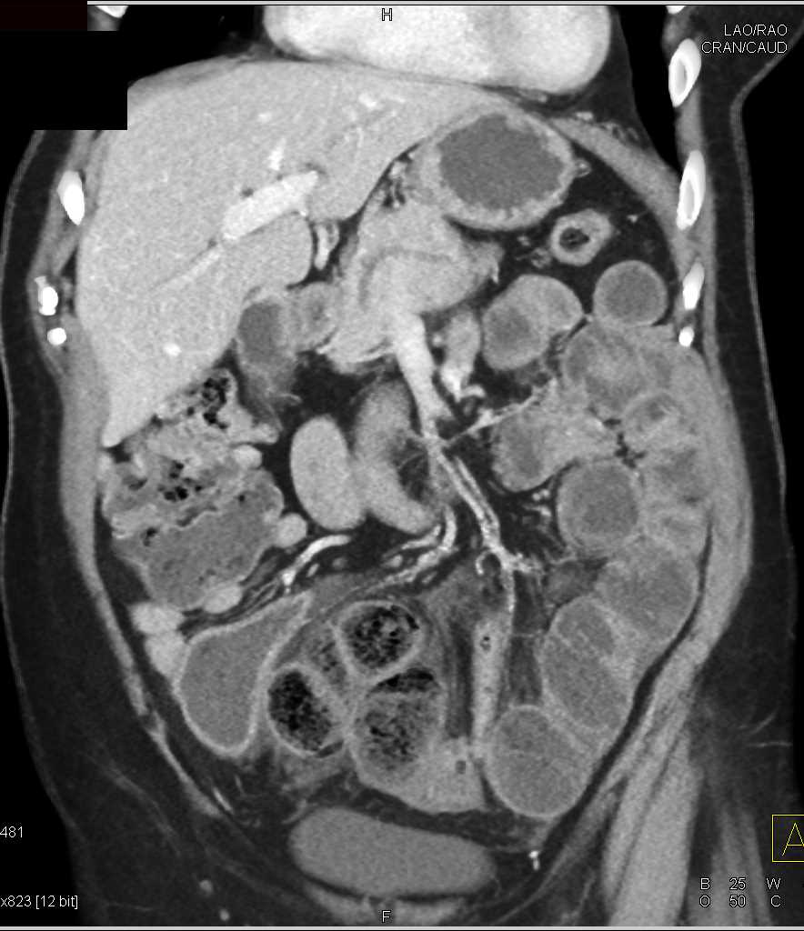 Feces Sign Terminal Ileum with Concern for Distal Small Bowel Obstruction by mass - CTisus CT Scan