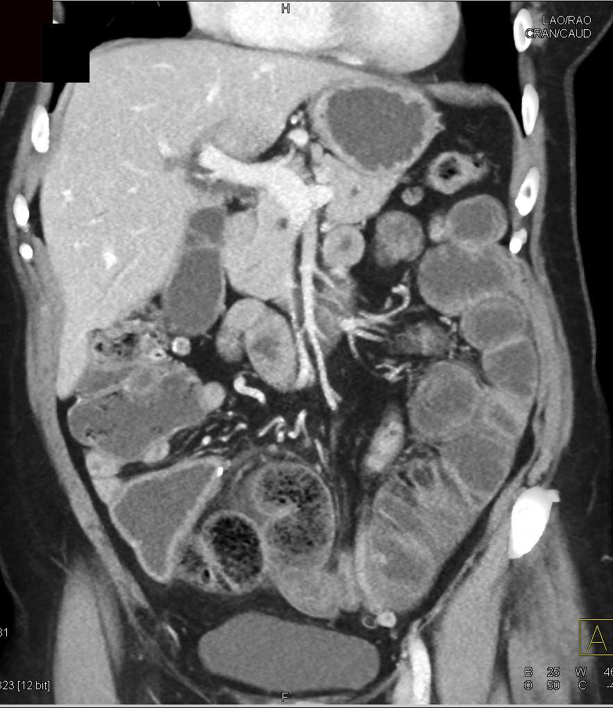 Feces Sign Terminal Ileum with Concern for Distal Small Bowel Obstruction by mass - CTisus CT Scan