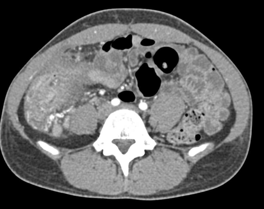 Colitis Right Colon with Dilated Small Bowel - CTisus CT Scan