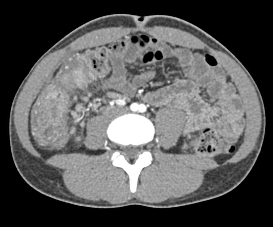 Colitis Right Colon with Dilated Small Bowel - CTisus CT Scan