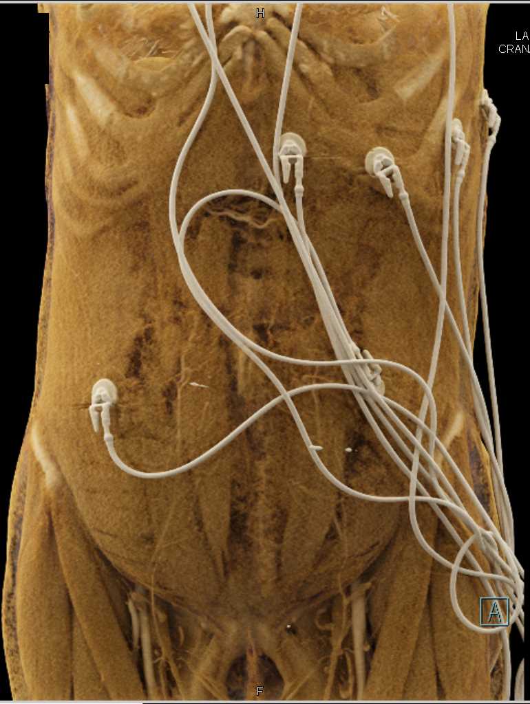 Cecal Cancer with Small Bowel Obstruction (SBO) with Cinematic Rendering - CTisus CT Scan