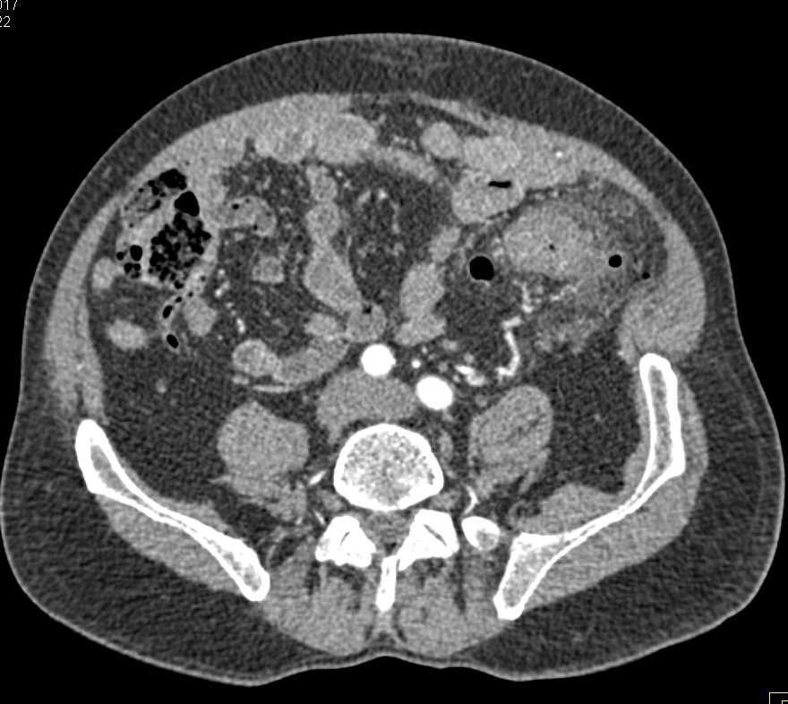 Diverticulitis Descending Colon - CTisus CT Scan