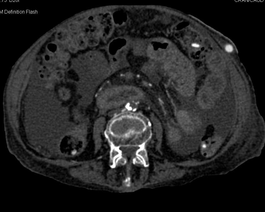 Colitis Transverse Colon - CTisus CT Scan