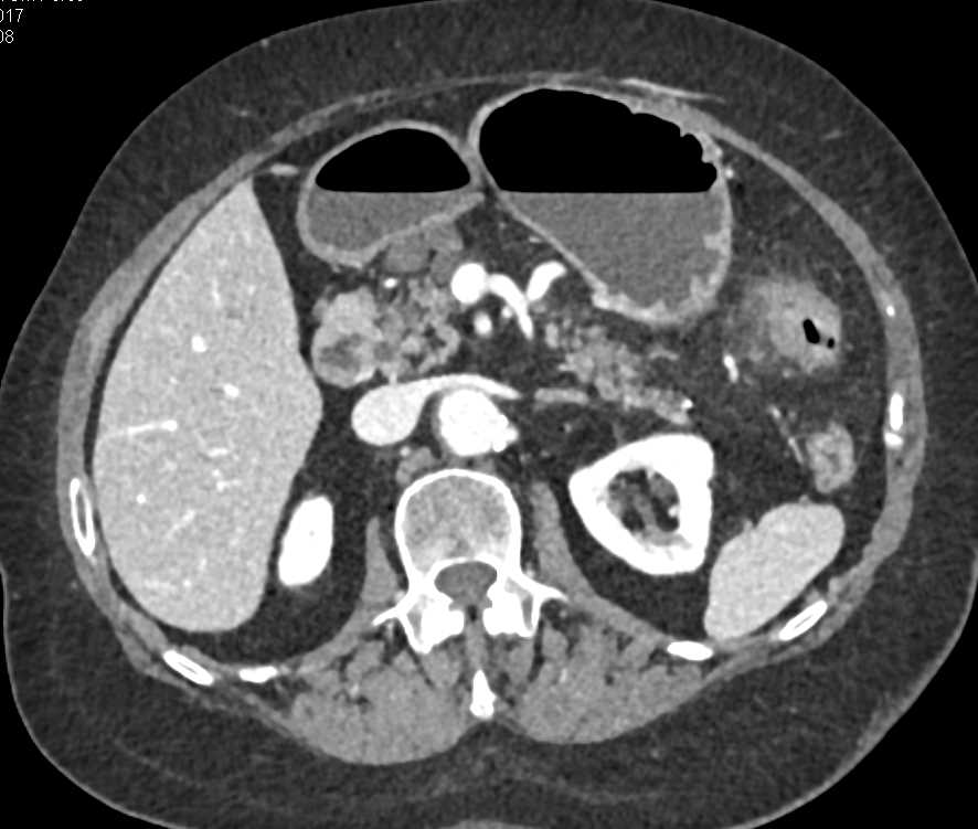 Colitis Descending Colon - CTisus CT Scan