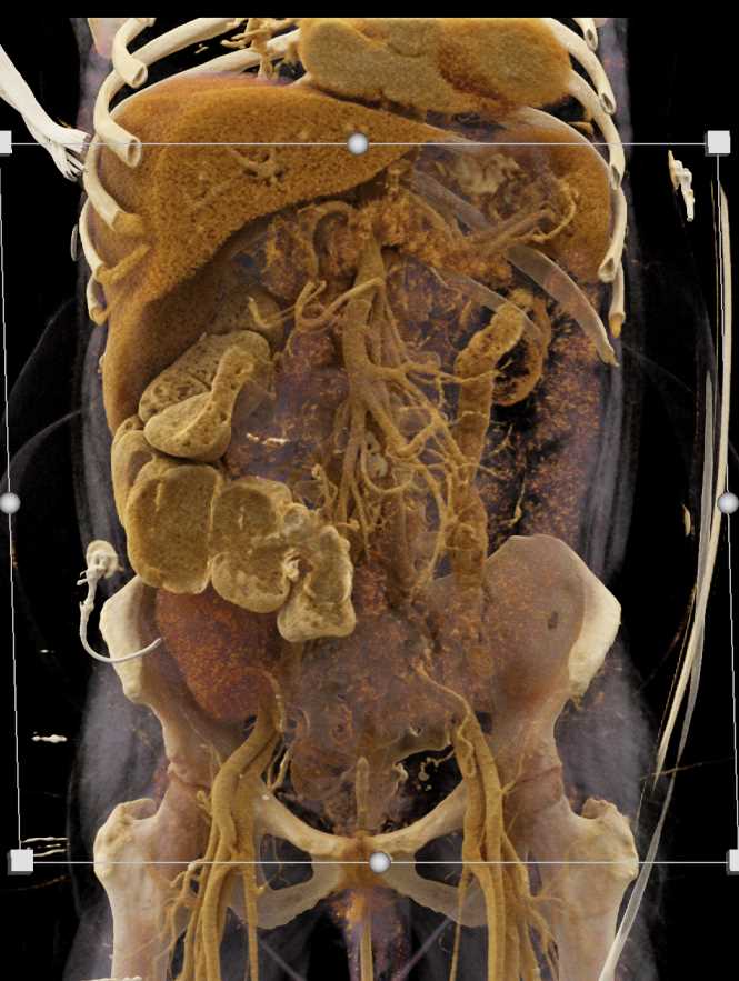 Cinematic Rendering of the Colon - CTisus CT Scan