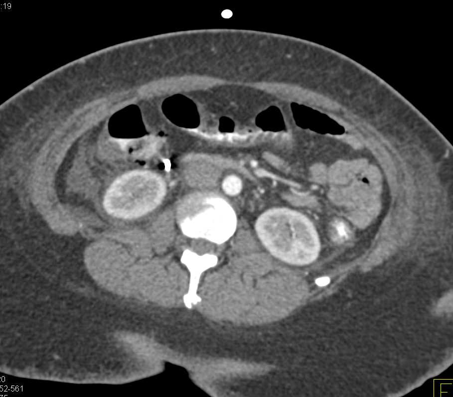 Pseudomembranous Colitis Right Colon - CTisus CT Scan