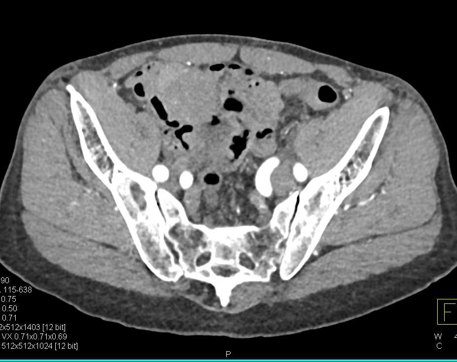 Appendiceal Carcinoma - CTisus CT Scan